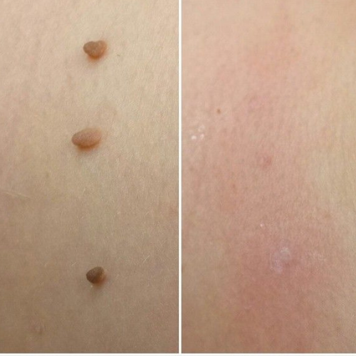 LUMIVO™ – No More Skin Tags. Safe, Gentle & Effective Results ✨