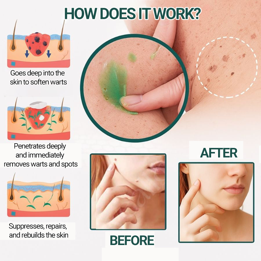 LUMIVO™ | Clinically proven to remove 97% of moles, warts, and skin imperfections — permanently in just 3 days!
