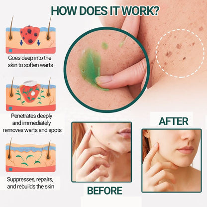 LUMIVO™ | Clinically proven to remove 97% of moles, warts, and skin imperfections — permanently in just 3 days!