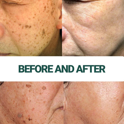 LUMIVO™ | Clinically proven to remove 97% of moles, warts, and skin imperfections — permanently in just 3 days!