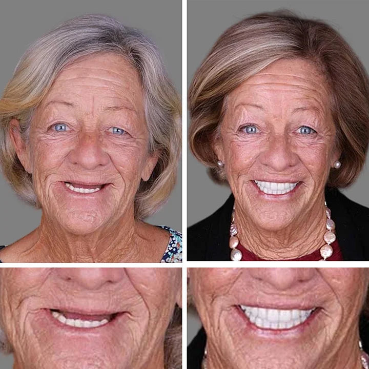 Ends Today: 58% OFF! ⏰58% OFF! EETTSY™ Medical Full Denture with Strong Suctiond Custom-Fit Full Functional Dentures🦷Obtain American Dental Association (ADA) Certification