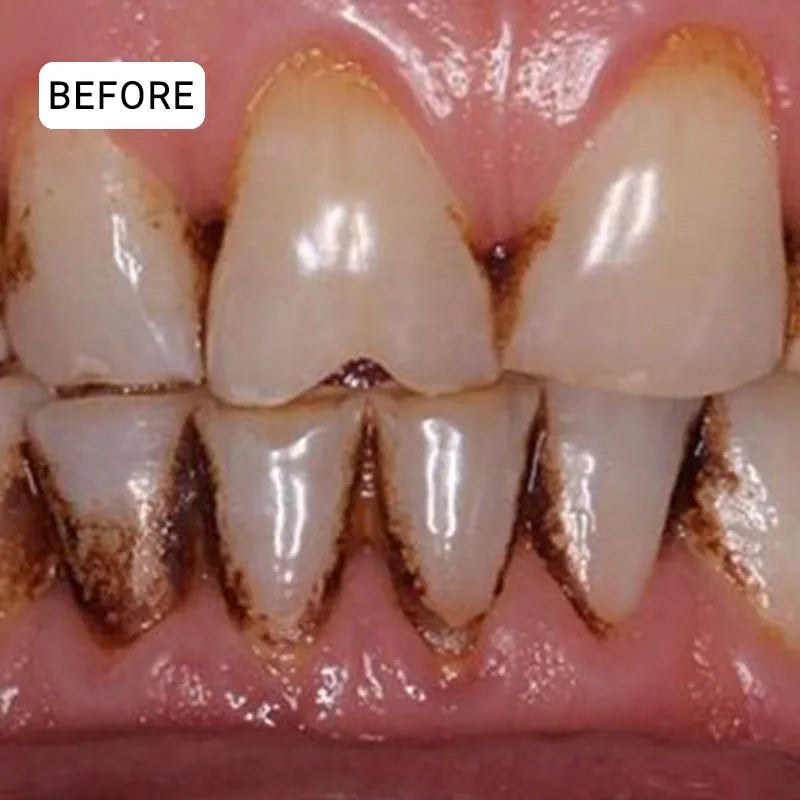 Sylovona Glow™ Dissolves Tartar and Rebuilds Your Gums Without Surgery