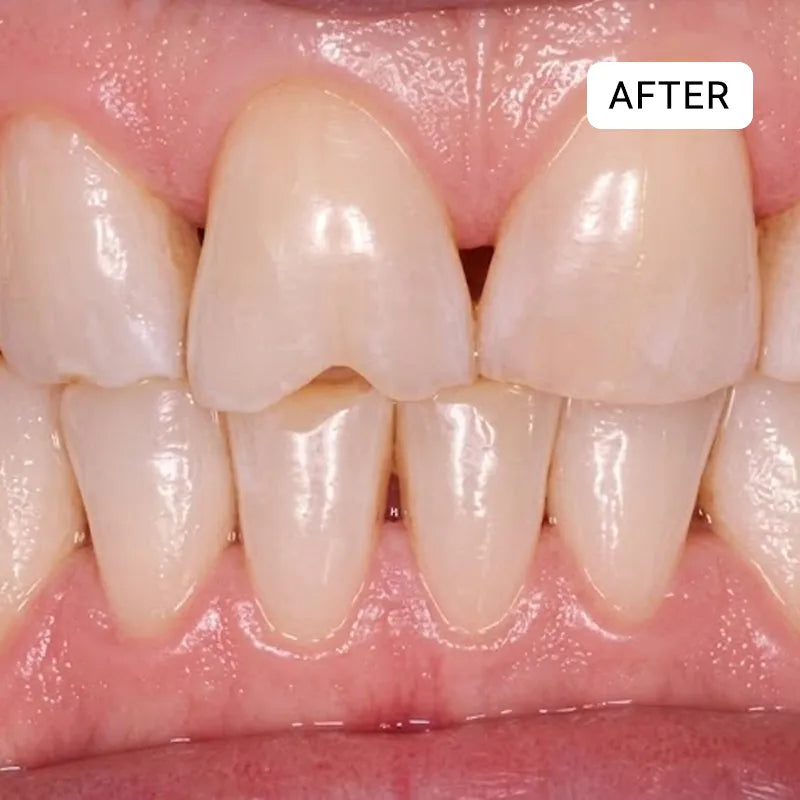 Sylovona Glow™ Dissolves Tartar and Rebuilds Your Gums Without Surgery