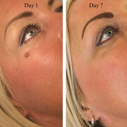 LUMIVO™ – No More Skin Tags. Safe, Gentle & Effective Results ✨