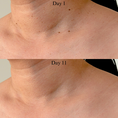 LUMIVO™ – No More Skin Tags. Safe, Gentle & Effective Results ✨