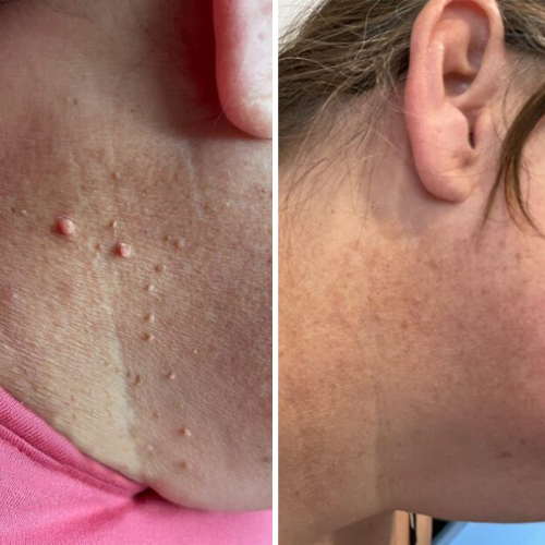LUMIVO™ – No More Skin Tags. Safe, Gentle & Effective Results ✨