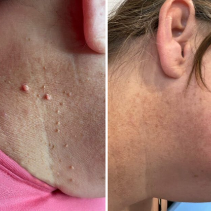 LUMIVO™ – No More Skin Tags. Safe, Gentle & Effective Results ✨