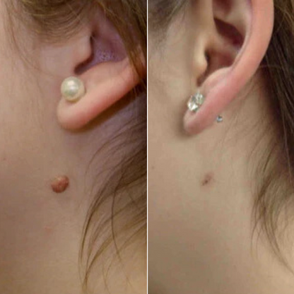 LUMIVO™ – No More Skin Tags. Safe, Gentle & Effective Results ✨